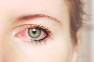 Allergies and What it Might Mean For Your Eyes