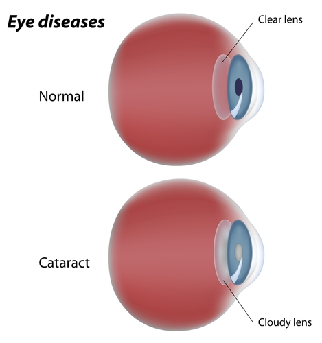 Clear Lens vs Cloudy Lens