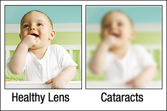 Healthy lens vs. one with Cataracts