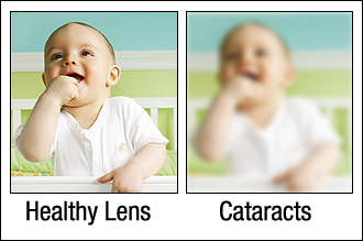 The difference between a healthy and clouded lens.