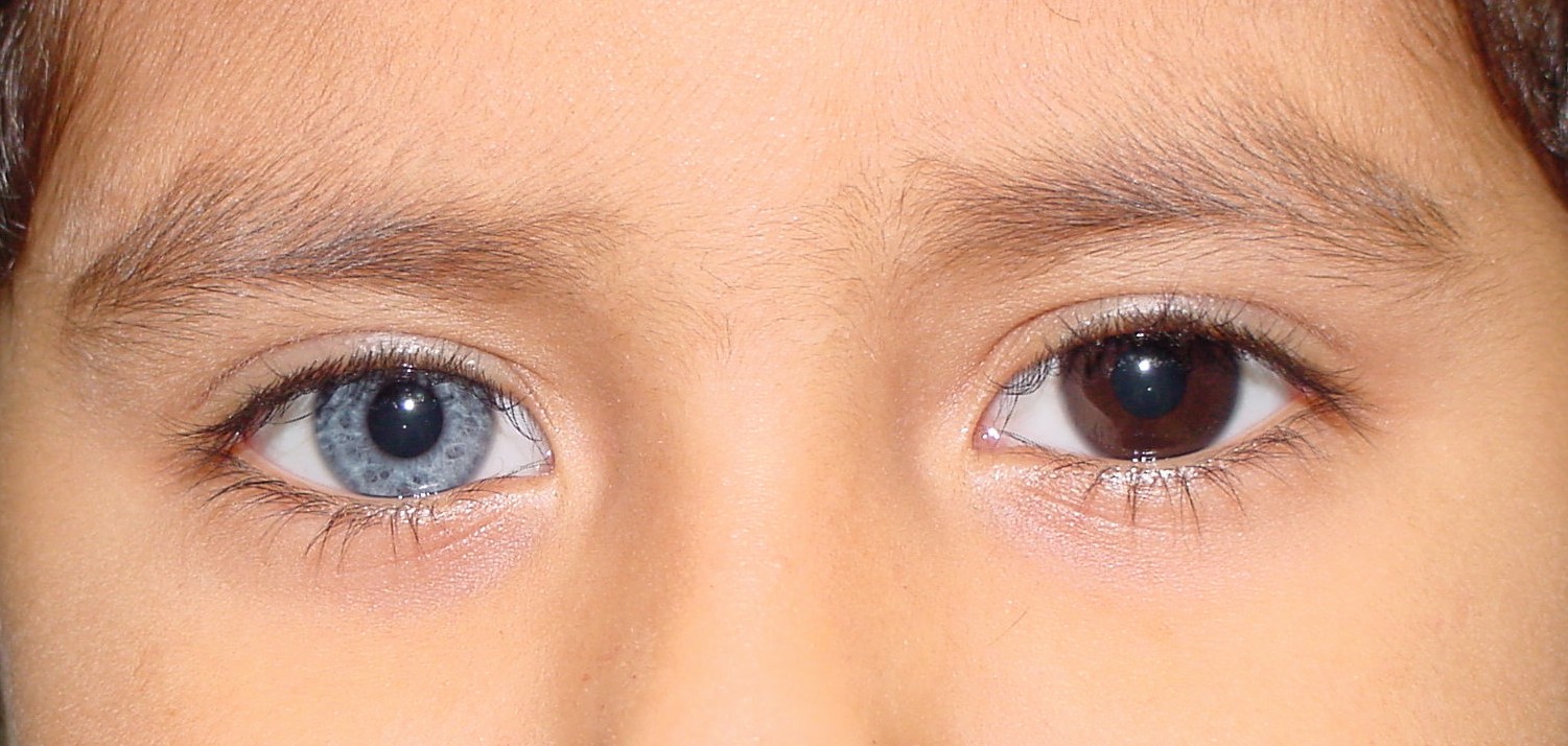 Heterochromia